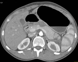 Pancreatic Laceration S/P Trauma- Tail - CTisus CT Scan