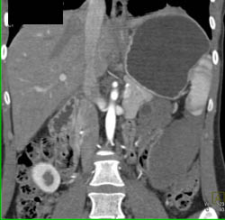 Desmoid Tumor Surrounds Pancreatic Bed - CTisus CT Scan