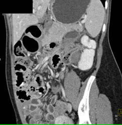 Pancreatic Laceration - CTisus CT Scan