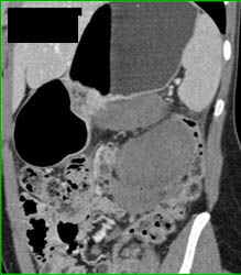 Desmoid Tumor - CTisus CT Scan