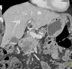 Pancreatic Adenocarcinoma Encases the Superior Mesenteric Vein (SMV) - CTisus CT Scan