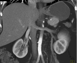 Cystadenoma - CTisus CT Scan