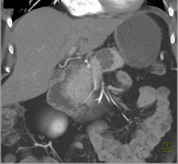 Cystadenoma - CTisus CT Scan