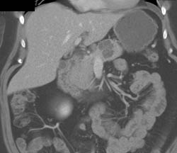 Cystadenoma - CTisus CT Scan