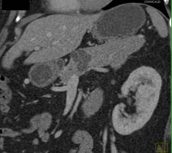 Cystadenoma - CTisus CT Scan