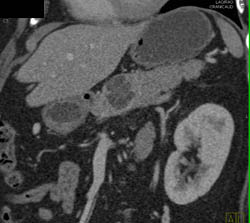 Cystadenoma - CTisus CT Scan