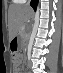 Nodes Encase SMA -negative Biopsy - CTisus CT Scan