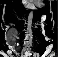 Pancreatic Cancer Encases the SMA and Left Renal Artery - CTisus CT Scan