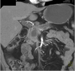 Pancreatic Cancer Encases the PV/SMV - CTisus CT Scan