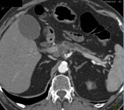 Pancreatic Cancer Encases the Celiac Artery - CTisus CT Scan