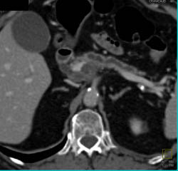 Pancreatic Cancer Encases the PV/SMV - CTisus CT Scan