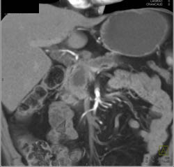 Pancreatic Cancer Encases the PV/SMV - CTisus CT Scan