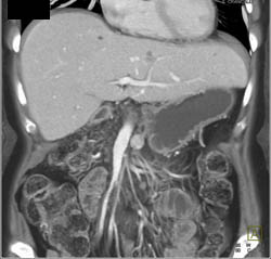 Fatty Infiltration of the Pancreatic Head - CTisus CT Scan