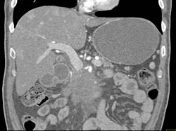 Pancreatic Cancer Encases the PV/SMV and the SMA - CTisus CT Scan