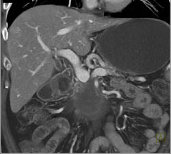 Gastrostomy Tube - CTisus CT Scan