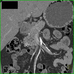 Pancreatic Cancer Occludes the Superior Mesenteric Vein (SMV) With Collaterals - CTisus CT Scan