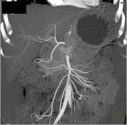 SMA and Celiac Axis With MIP - CTisus CT Scan