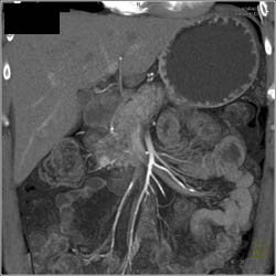 Insulinoma - CTisus CT Scan