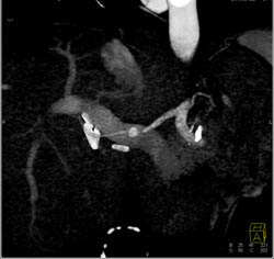 Insulinoma - CTisus CT Scan