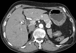 Metastatic Renal Cell Carcinoma to Liver and Pancreas- Arterial and Venous Phase Images - CTisus CT Scan