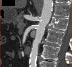 Stent SMA That Is Patent- See Series of Images - CTisus CT Scan