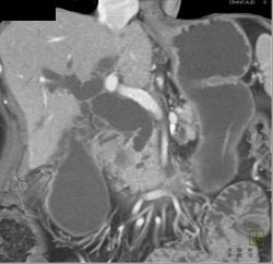 Pancreatic Cancer Obstructed the Common Bile Duct - CTisus CT Scan