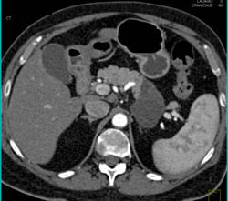 Cystadenoma - CTisus CT Scan