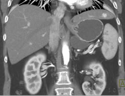 Cystadenoma - CTisus CT Scan