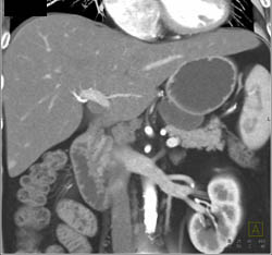 Cystadenoma - CTisus CT Scan