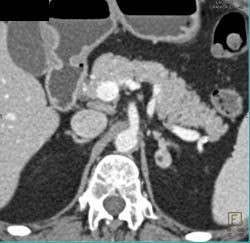 Normal Pancreas and Left Adrenal Adenoma - CTisus CT Scan