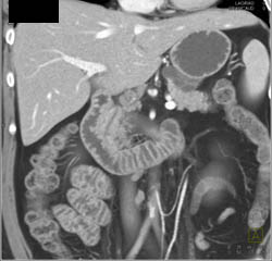 Pancreatic Cancer Encases the PV/SMV Confluence - CTisus CT Scan