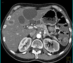 Pancreatic Cancer With Liver Cysts and Metastases. Tumor Encases the Celiac Axis - CTisus CT Scan