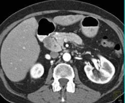 Pancreatic Cancer - CTisus CT Scan