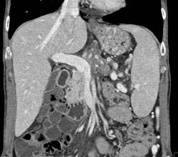 Occluded Splenic Vein Due to Pancreatic Mass - CTisus CT Scan