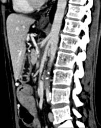 Superior Mesenteric Artery (SMA) Syndrome - CTisus CT Scan