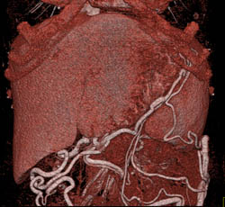 Collaterals Around the Liver - CTisus CT Scan