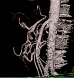 Celiac Stenosis With Collaterals Through the Gastroduodenal Artery (GDA) and SMA - CTisus CT Scan