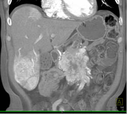 Islet Cell Carcinoma With Vascular Liver Metastases - CTisus CT Scan