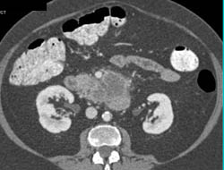 Pancreatic Adenocarcinoma - CTisus CT Scan