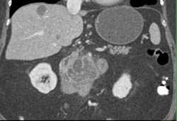 Pancreatic Adenocarcinoma - CTisus CT Scan