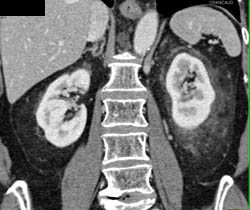 Intraductal Papillary Mucinous Neoplasm (IPMN) Off the Pancreatic Duct - CTisus CT Scan