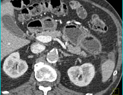 Fluid Collection Near Pancreas - CTisus CT Scan