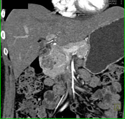 Cystadenoma in the Pancreatic Head - CTisus CT Scan