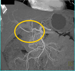 Pancreatic Cancer Encases the Hepatic Artery - CTisus CT Scan