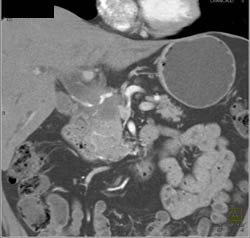 Pancreas Cancers Encase the Hepatic Artery - CTisus CT Scan