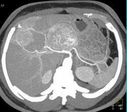 Metastatic Islet Cell Tumor - CTisus CT Scan