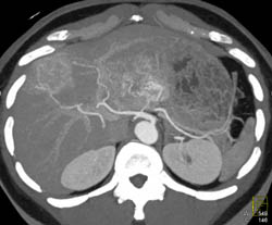 Metastatic Islet Cell Tumor - CTisus CT Scan