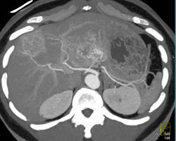 Metastatic Islet Cell Tumor - CTisus CT Scan