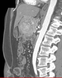 Metastatic Islet Cell Tumor - CTisus CT Scan