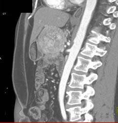 Metastatic Islet Cell Tumor - CTisus CT Scan